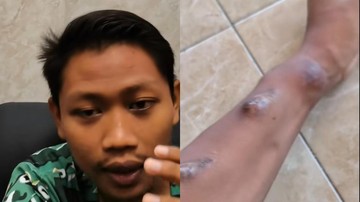 Inspiratif, Pemuda Tuban Edi Utomo Pertaruhkan Masa Muda Demi Rutinitas Cuci Darah Akibat Gagal Ginjal Kronis
