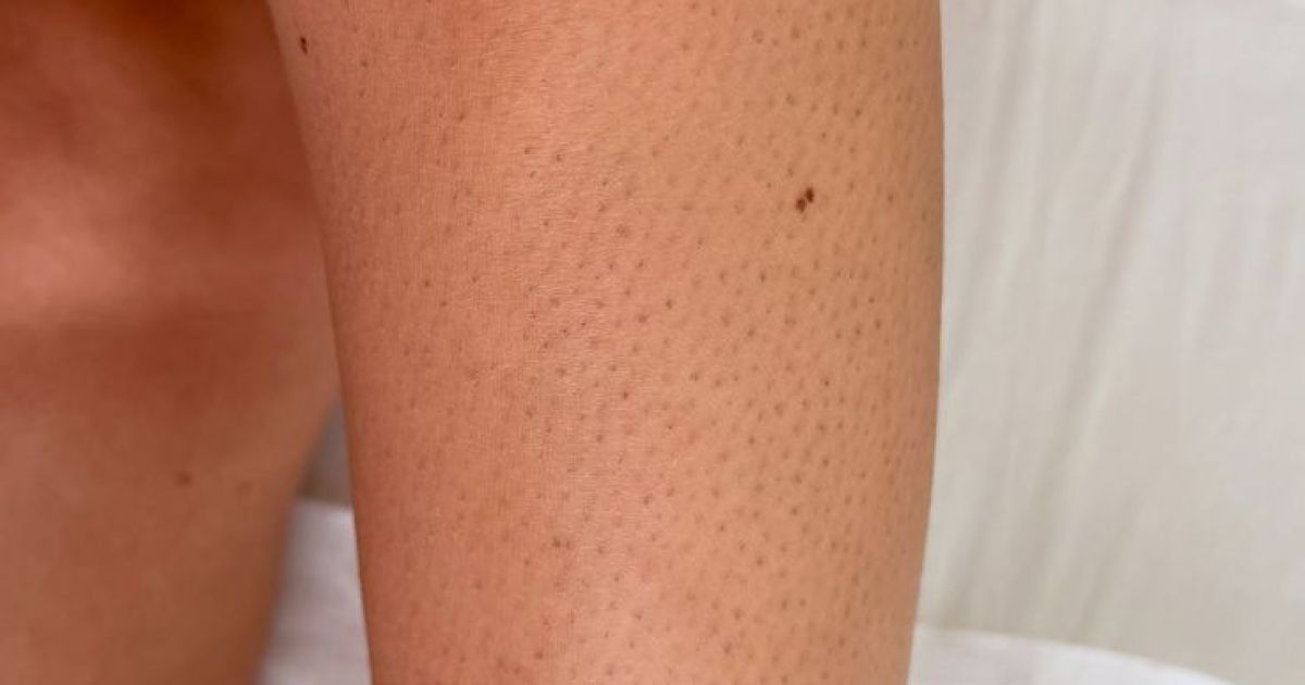 Ilustrasi strawberry skin yang terjadi pada kaki [Foto:Pinterest]