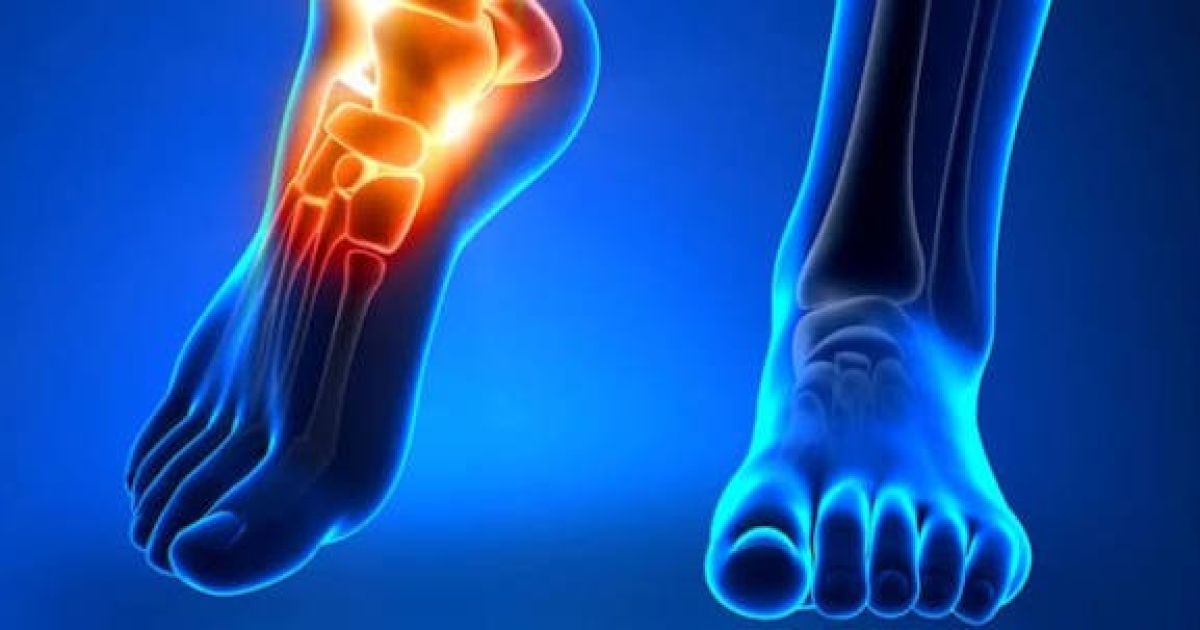 Lakukan Metode Ini sebagai Pertolongan Pertama Cedera Ankle agar Tidak Kronis